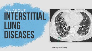 Interstitial Lung Diseases Or Diffuse Parenchymal Lung Diseases  A Brief Overview [upl. by Admama]