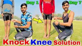 Knock knee कैसे ठीक करें  Knock knee problem solution  knock knees best exercise and tips in hindi [upl. by Ettellocin379]