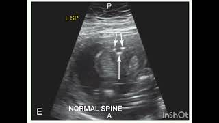 Ultrasound of Normal Spine and Meningomyelocele Review from the book Requisites of Ultrasound [upl. by Fahland]