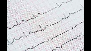 ecg interpretation made easy [upl. by Enitsed522]