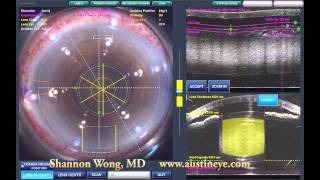 Lensx laser cataract surgery  brunescent cataract 101512 [upl. by Jaye]