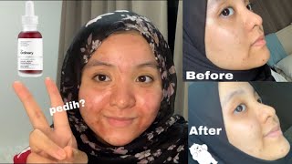 Review Peeling Solution The Ordinary Chemical Exfoliator Malaysia [upl. by Glovsky]