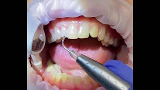 Laser Bacterial Reduction with the Biolase Epic Hygiene Diode Laser [upl. by Rumney]