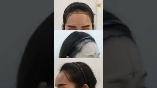 Receding hairline Reka Hairline Impian Anda  HAIR TRANSPLANT MALAYSIA [upl. by Acisey]