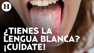 ¡Problemas del hígado e intestinales Si tienes la lengua blanca esto te interesa [upl. by Ledeen764]