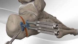 Flatfoot Repair with Arthrex® Calcaneus Step Plate [upl. by Albin]