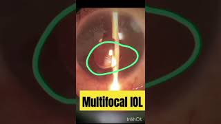 Multifocal IOL  iol eyelens eyediseases [upl. by Relluf]