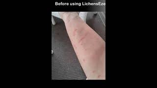 LichensEze Lichen Planus Relief cream Cure the rash guaranteed [upl. by Adelaida433]