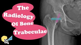 The Radiology of Bone Trabeculae [upl. by Aip]