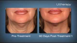 Ultherapy Before and After Photos Testimonials from Patients and a Treatment Demonstration [upl. by Nerdna246]