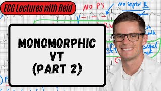 Monomorphic VT Part 2  Day 22 ECG Challenge [upl. by Nais438]