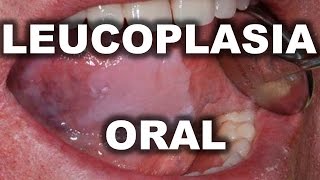 LEUCOPLASIA ORAL  PARCHES EN LENGUA BOCA Y CARA INTERNA DE LAS MEJILLAS [upl. by Callery520]