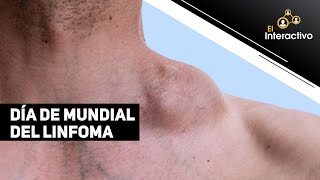 Linfoma causas síntomas y tratamiento [upl. by Nekciv]