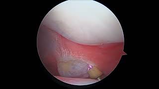 Arthroscopic Lateral Retinacular Lengthening Procedure [upl. by Pippo]