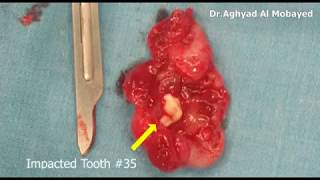 Dr Aghyad  Dentigerous cyst of mandible  excisional biopsy [upl. by Winni21]