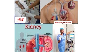 Roles of a renal nurse what is a haemodialysis Catheter [upl. by Rube339]