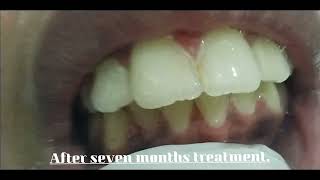 COMPLETE ORTHODONTICS TREATMENT OF REAL PATIENT FOR IRREGULARLY ARRANGED TEETH [upl. by Marra770]