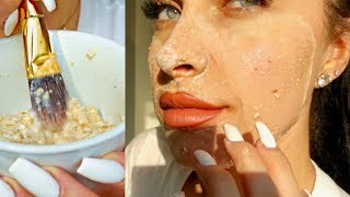 DIY CLEAR SKIN FACE MASK  How To Get Rid of Pimples  Acne Overnight At Home 100 Natural [upl. by Enomal426]