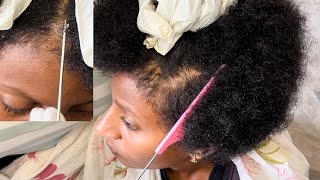 ASMR  Dandruff Removal amp Scalp Check Extremely Relaxing [upl. by Marrissa]