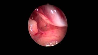 Endoscopic CSF Perilymph Leak [upl. by Navannod967]