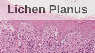 Lichen Planus  Pathology mini tutorial [upl. by Persas205]