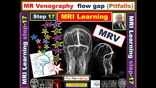 MRV Flow GAP pitfalls Venous sinus thrombosis versus hypoplasia MRI learning Episode 17 [upl. by Jodee719]