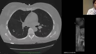 Catamenial pneumothorax review of peritoneal flow  Dr Aarti Sekhar [upl. by Notsag]