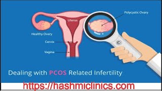 PCOS and Infertility  hashmiclinics  Prof Dr Rifat Hashmi [upl. by Giavani]