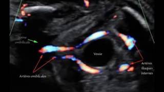 Artères ombilicales au cours de la vie foetale  Trajet pelvien coiffant la vessie [upl. by Adnilemre]