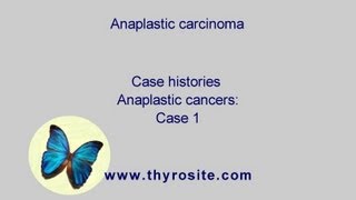 Anaplastic carcinoma  case 1 [upl. by Hulburt]