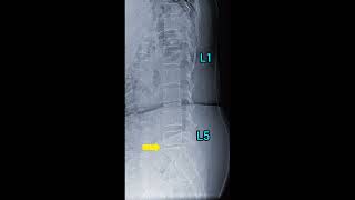 Intravertebral Disc SpaceIVD shortsvideo [upl. by Auqinal]