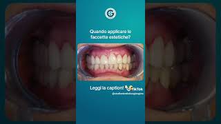 Prima e dopo  Faccette dentali [upl. by Bolan]