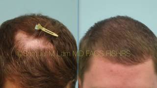 Dallas Hair Transplant for Scarring Alopecia LPP [upl. by Ytsrik532]