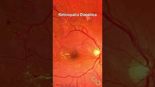 Retinopatia diabética proliferativa [upl. by Angelika78]