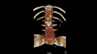 L45 spondylolytic spondylolisthesis [upl. by Maroney]