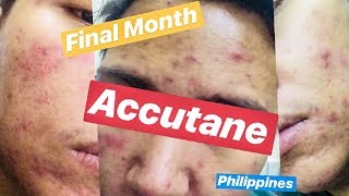 MY ACCUTANE JOURNEY FINAL MONTH UPDATE ISOTRETINOIN Side Effects PHILIPPINES [upl. by Arakal]