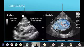 21 04 13 Pericardiocentesis lecture [upl. by Abekam]