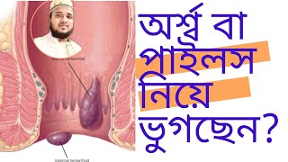 অর্শ্ব বা পাইলস এর হোমিওপ্যাথি সহজ সমাধানArso ba pails er homeo medicine helth tips for pails [upl. by Marlane414]