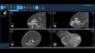 Koning Health Clinical Review Ductal Carcinoma in Situ Calcifications [upl. by Koah]