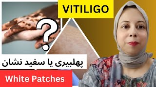 سکن پہ سفید داغ اور پھلبیری میں فرق White Patches And Vitiligo Treatment [upl. by Isla]