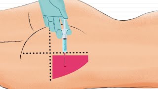 Como Aplicar Inyección Intramuscular en el GLUTEO 🍑 [upl. by Chrisman864]