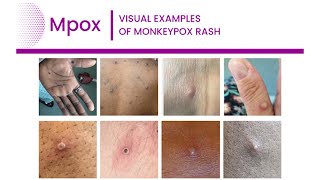 4th Confirmed Case Of Monkey Pox In TampT [upl. by Yrome732]