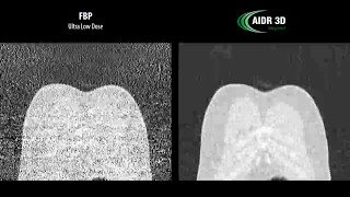 AIDR 3D Enhanced Integrated Ultra Low Dose Chest [upl. by Theurich]