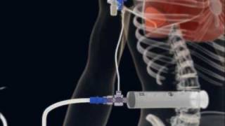 How to make a Thoracentesis pleural puncture with Pleurasafe  short 3D animationflv [upl. by Brannon]