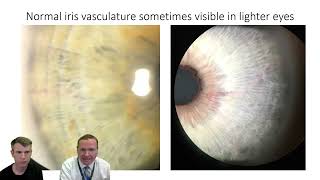 Treatment of narrow angles Laser Peripheral Iridotomy with hemorrhage [upl. by Stockton]