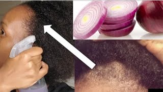 COMMENT UTILISER LE JUS DOIGNON POUR LA POUSSE EXTRÊME DES CHEVEUX 😱 [upl. by Aiet]