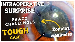 Intraoperative surprises and Phaco challenges in an eye with zonular weakness quotTough Casequot [upl. by Anabahs473]