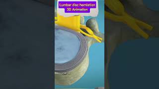 Lumbar Disc Herniation Causes Symptoms amp Treatment  Back Pain Reliefbackpain herniateddisc [upl. by Aneger]