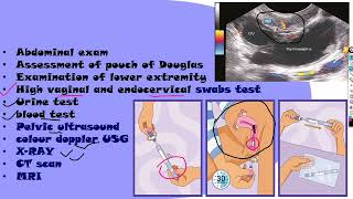 Puerperal sepsis part 2 NGMedicals [upl. by Fenella]