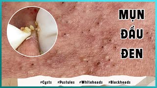 Big Cystic Acne Blackheads Extraction Blackheads amp Milia Whiteheads Removal Pimple Popping [upl. by Enyahc]